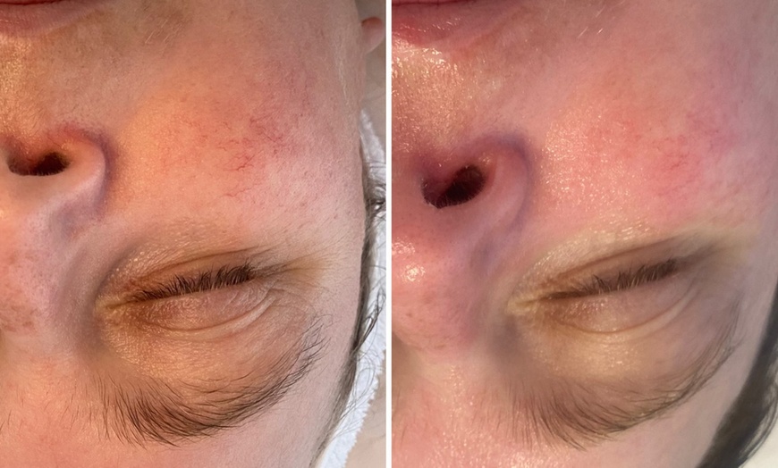 Image 7: Microneedling-Behandlung oder Enzym-Lifting-Paket für 1 Person