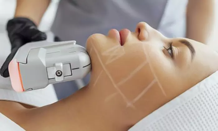 Lift & Tighten: HIFU Neck, Half Face, Full Face, Neck, or Body