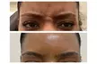 Get 36 Units of Baby Tox, OR Unlimited Tox - Upper Face Smoothing at Get Tox'd Botox Medspa (Up to 31% Off) - Second Medium