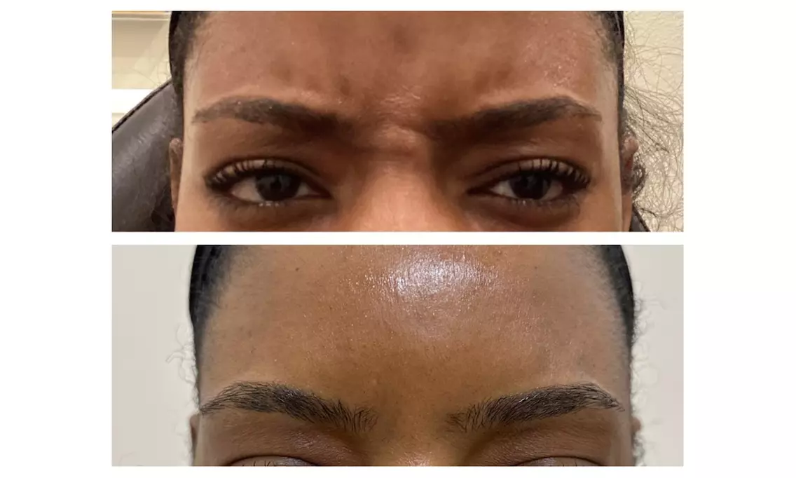 Get Baby Tox - 36 Units or Unlimited Tox for Full Face Smoothing
