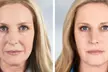 Achieve a Youthful Glow @ Perfect Aesthetics & Spa's One Vial Of Sculptra + Opt 20 Units of (Up To 40% Off) - Second Medium