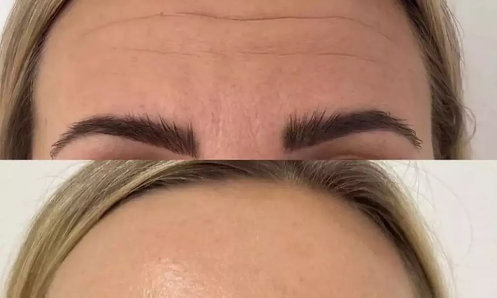  Revitalize Your Look with 20, 40, or 60 Units of Botox

