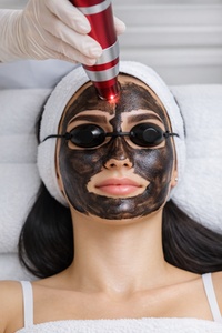 One Hollywood Chemical Peeling for Face - Vancouver star laser centre