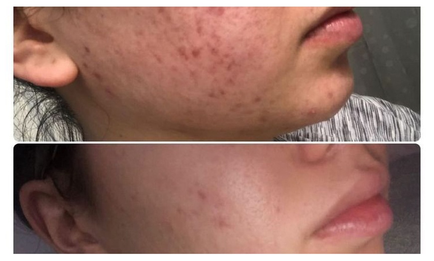Image 3: Refresh with a Microdermabrasion Facial Session!