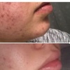 Image 3: Refresh with a Microdermabrasion Facial Session!