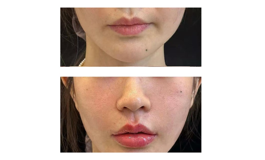 Image 2: Half/Full Syringe of Revanesse VERSA & LIP+ Injections For Smooth Skin
