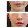 Image 2: Half/Full Syringe of Revanesse VERSA & LIP+ Injections For Smooth Skin
