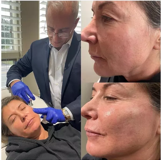 Youthful Confidence: 20 or 40 Units of Botox in Fair Lawn