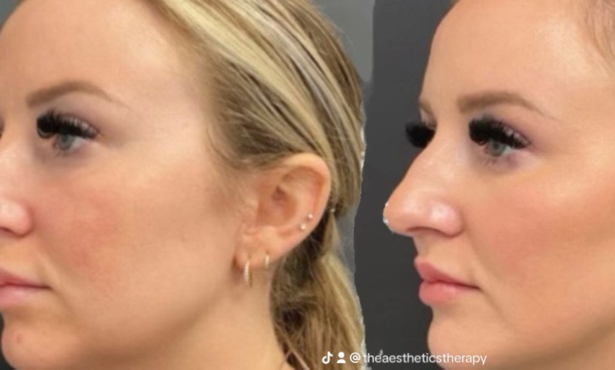 Image 3: Enhance Your Look with 0.5ml, 1ml or 2ml Dermal Filler