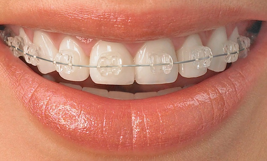 Image 1: Clear Fixed Braces