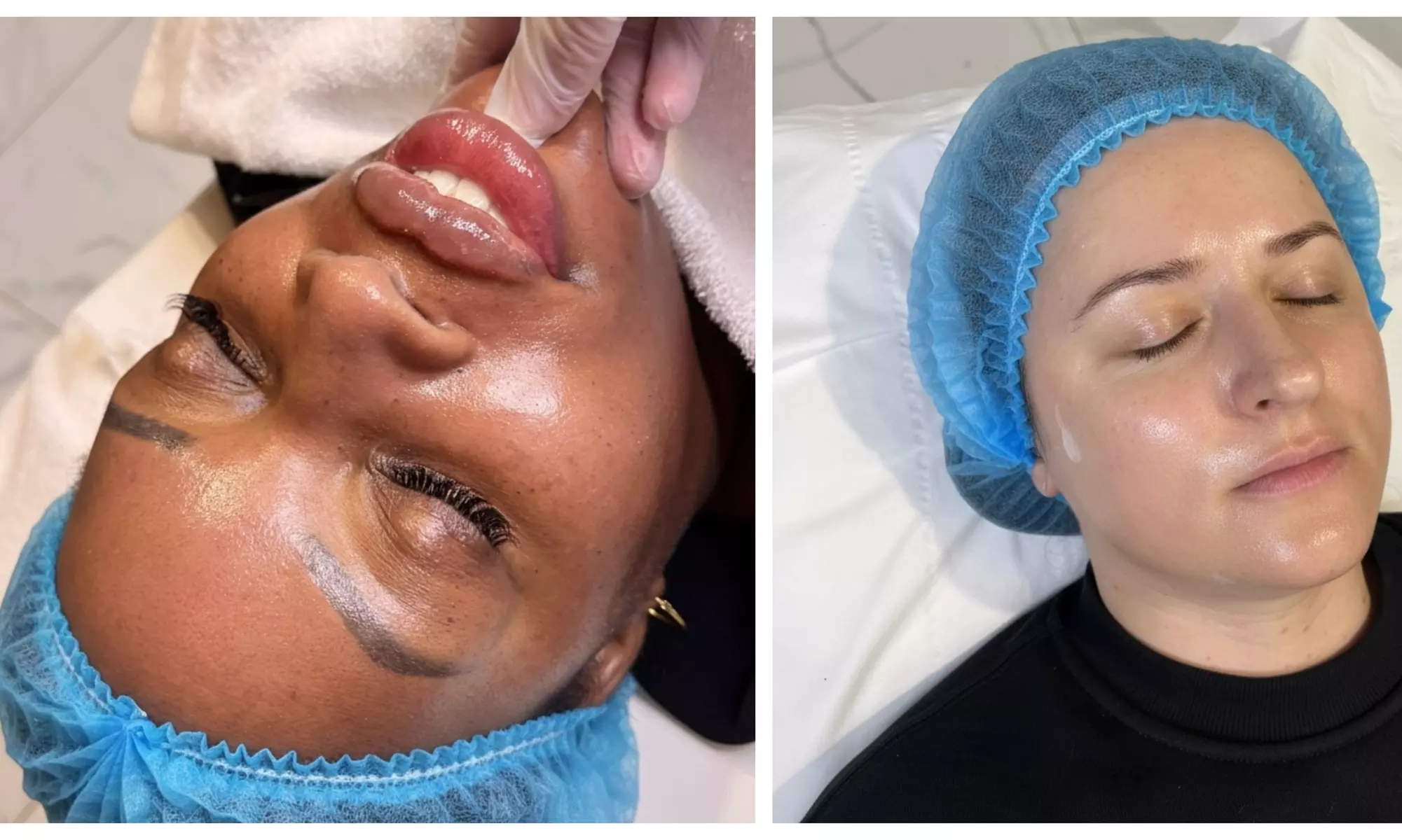 Three Sessions: Polynucleotide/Lumi Eyes (Under Eye or Face Treatment)