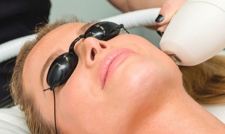 One IPL Photofacial for Broken Capillaries Around the Nose - McLean Body Contouring and Laser Center