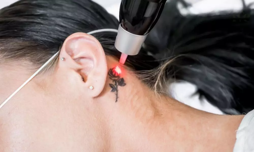Laser Tattoo Removal: Eyeliner, Eyebrows, Hairline, or Body Tattoos