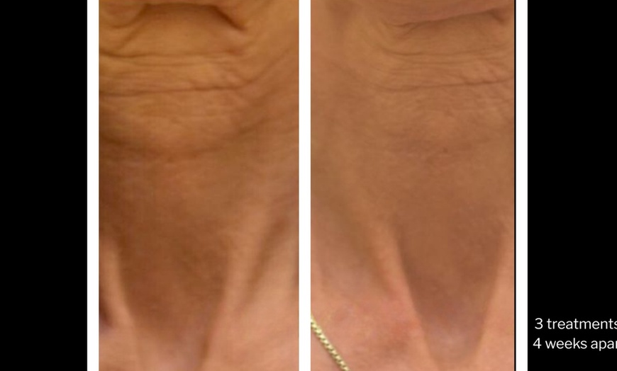 Image 11: Morpheus8 Non-surgical Tightening - Allure Passions Aesthetic Clinic