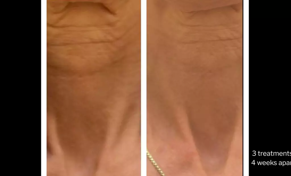 Morpheus8 Non-surgical Tightening - Allure Passions Aesthetic Clinic