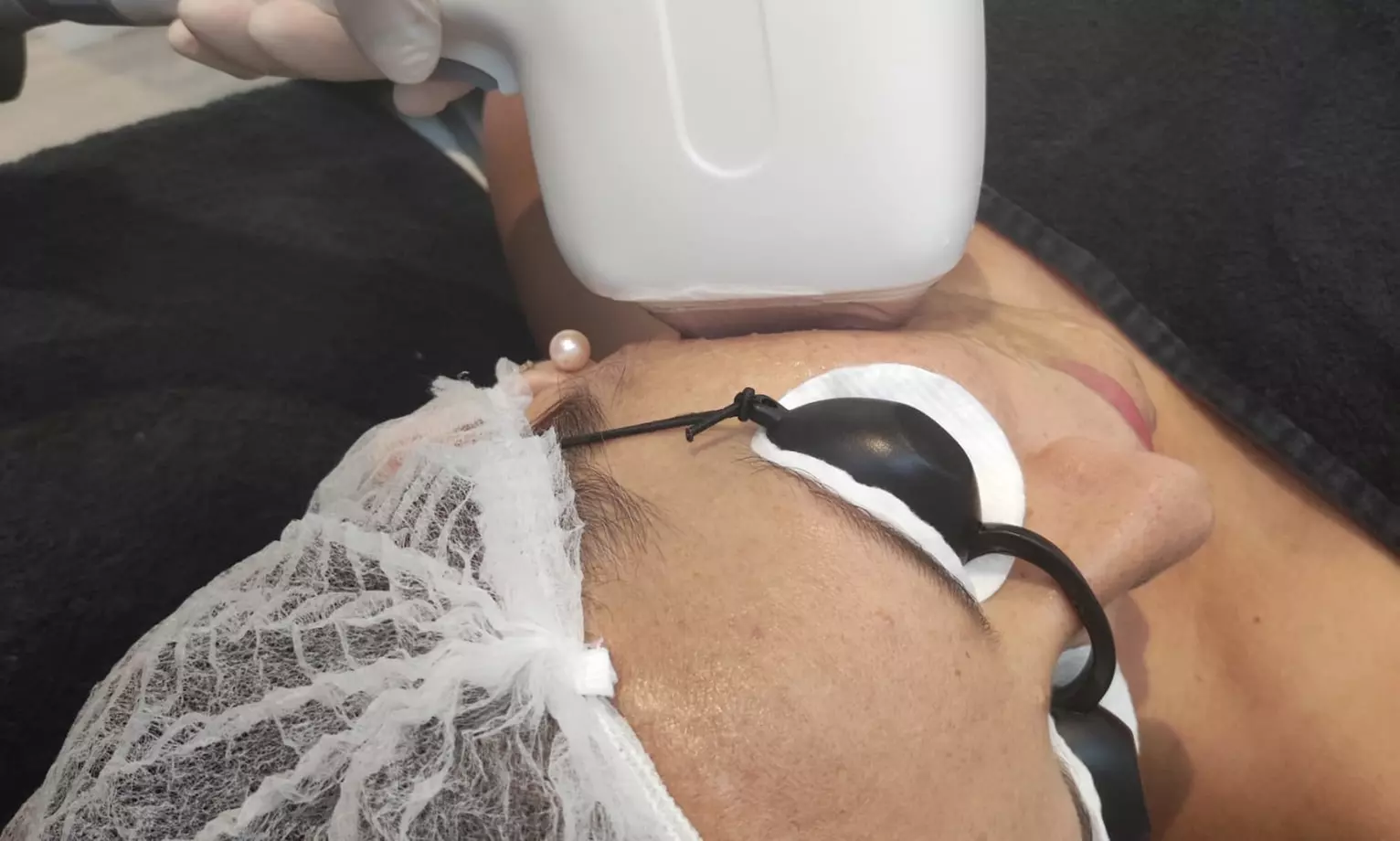 Tratamiento facial con láser en Sapphira Prive Madrid centro