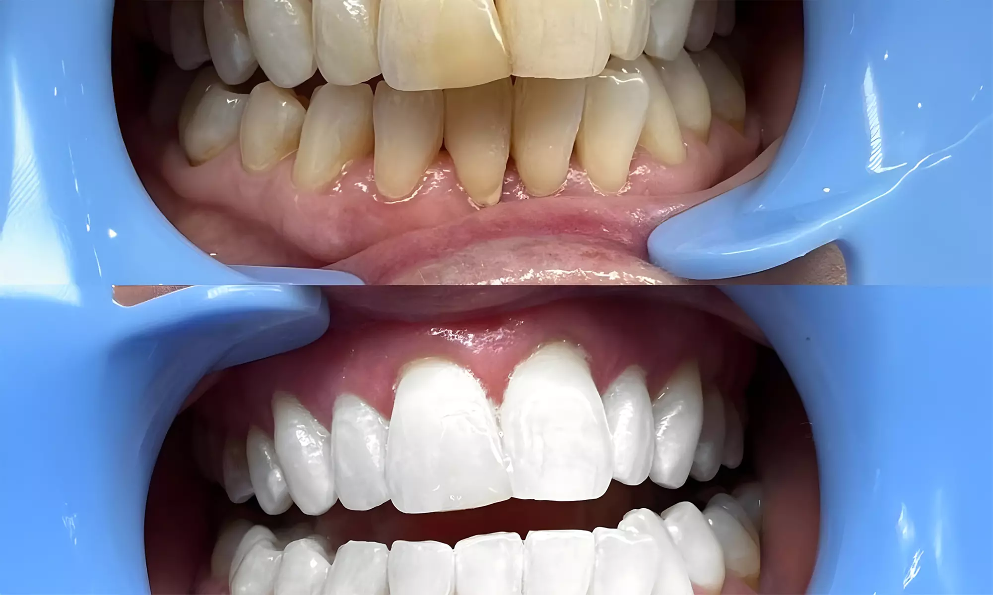Mini-Laser or Lux Pro Teeth Whitening with One or Two Treatments