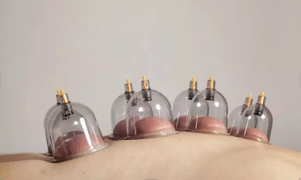 Experience Cupping Treatment with Custom massage 50-or 80-mins