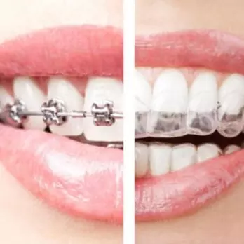 Transform Your Smile w/ Clear Lower or Upper Aligner, or Combo of Both