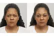 20 Units of Botox at BodyBrite Austin – Quick, Effective Results and Minimal Downtime - Up to 40%% Off - Second Medium
