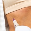 Image 1: Morpheus8 RF Micro-Needling for Face & Neck or Abdomen