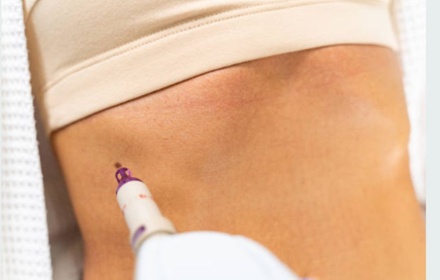 One Morpheus8 RF Microneedling Treatment for Face and Neck - Aurora Advanced Aesthetics