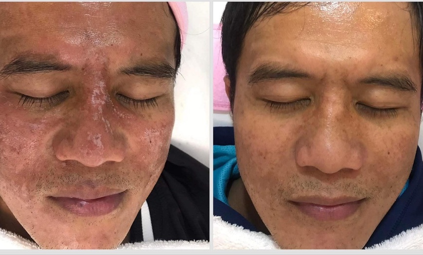 Image 9: One, Two or Three 60-Minute Signature Facials with Chemical Peels