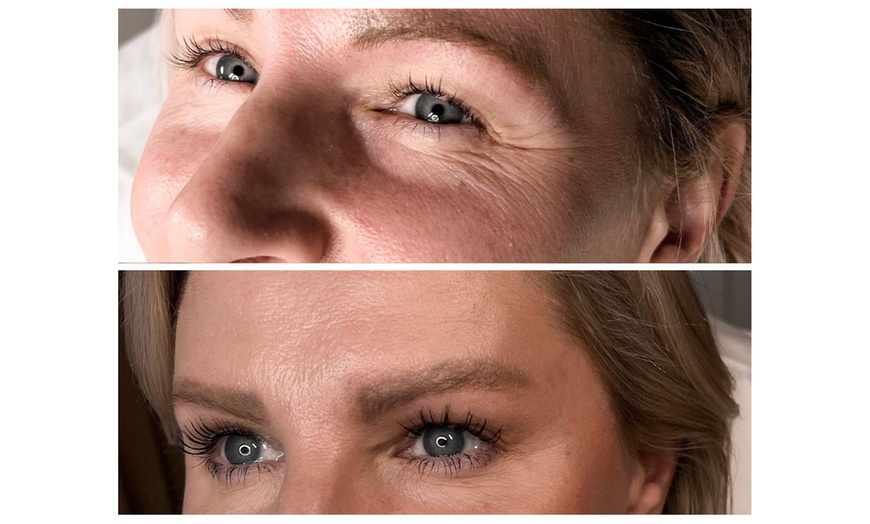 Image 4: Smooth Away Wrinkles with 20, 40 or 60 Units of Jeuveau