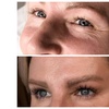 Image 4: Smooth Away Wrinkles with 20 Units of Jeuveau