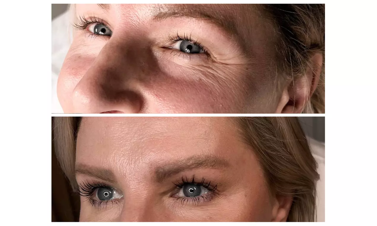 Smooth Away Wrinkles with 20, 40 or 60 Units of Jeuveau