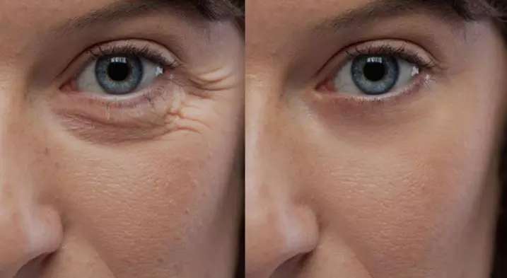 Revitalize Your Skin with 30 or 60 Units of Dysport