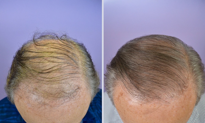 Image 3: Three PRP Tubes for Advanced Hair Restoration Treatment