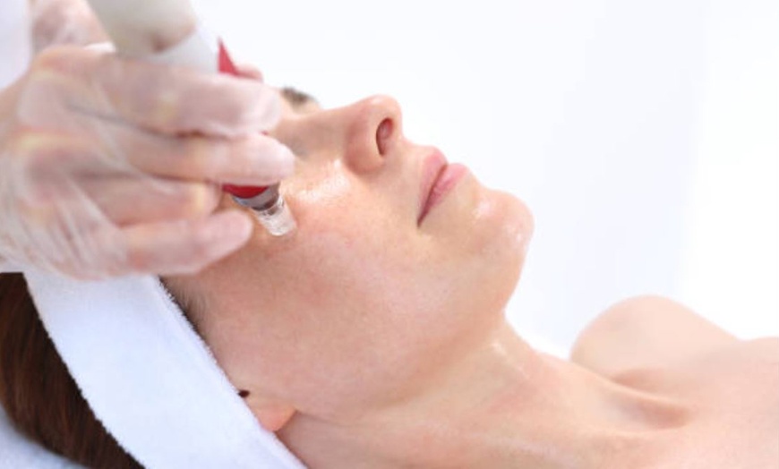 Image 12: 1 o 2 sesiones de rehidratación de labios o microlifting facial para 1