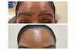 Get 36 Units of Baby Tox, OR Unlimited Tox - Upper Face Smoothing at Get Tox'd Botox Medspa (Up to 31% Off) - Second Medium