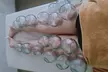 Acupuncture and Oriental Medicine Clinic Offers Fire Cupping or Air Compression Therapies (Up to 30% Off) - Second Medium