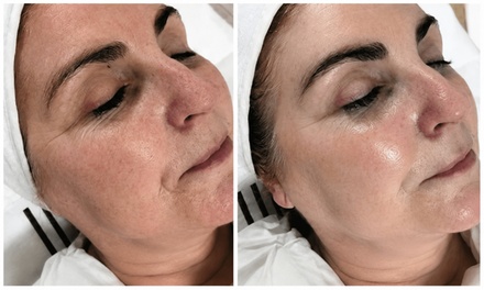 Luxury Korean C02 Carboxy Facial - Miami Beauty Spa