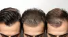 Transform Your Hair w/ 1 or 2 Sessions of Laser Hair Restoration + Consultation at Natural Touch (Up to 50%Off)