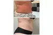 10 Cryo Slimming Body Sculpting Sessions, 1 or 5 Cryo Slimming Sessions / 3 Cryo Facial Sessions (Up to 50% Off) - Second Medium