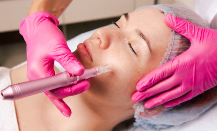Image 1: Achieve Radiant Skin with One or Three Microneedling Sessions