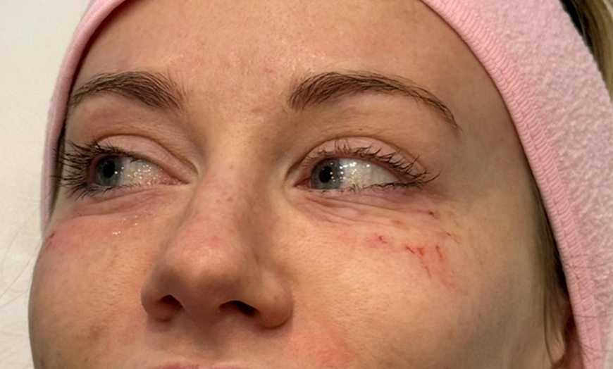 Image 2: Polynucleotide, Smooth line injections & Filler Combos 