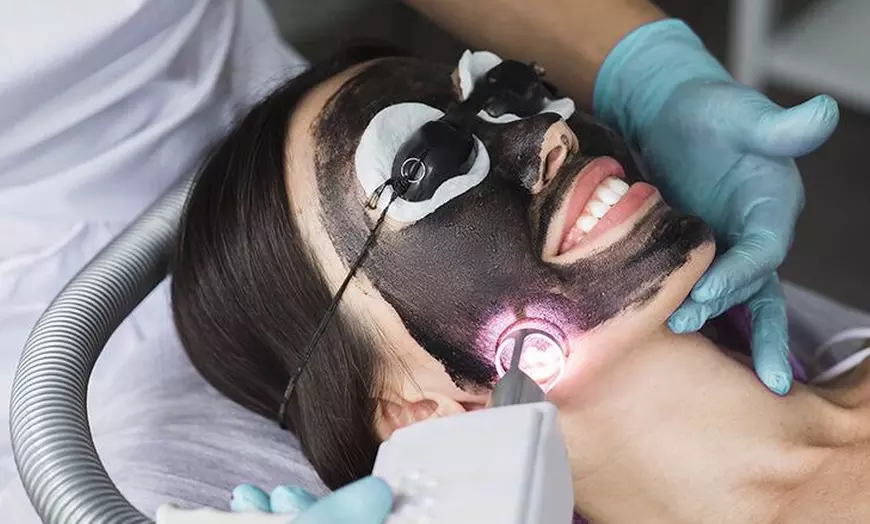 Image 1: Hollywood peeling con carbón activo y láser o limpieza facial prémium 
