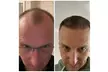 Full Hair Restoration with Up to 3000-Graft FUE Transplant for a Seamless, Natural Look (Up to 33% Off) - Second Medium