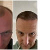 Image 7: Natural-Looking Hair Restoration with Up to 3000-Graft FUE Transplant