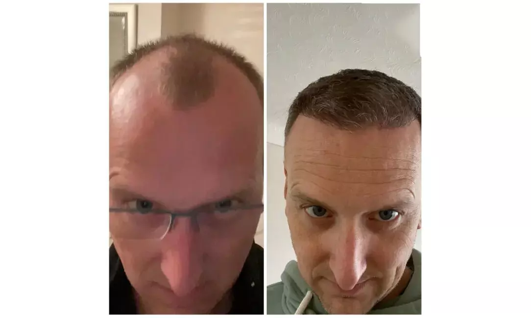 Natural-Looking Hair Restoration with Up to 3000-Graft FUE Transplant