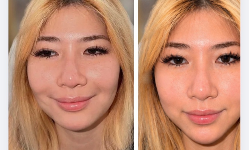Image 8: Revanesse Versa Dermal Filler: Natural Lip & Facial Enhancement