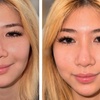 Image 8: Revanesse Versa Dermal Filler: Natural Lip & Facial Enhancement