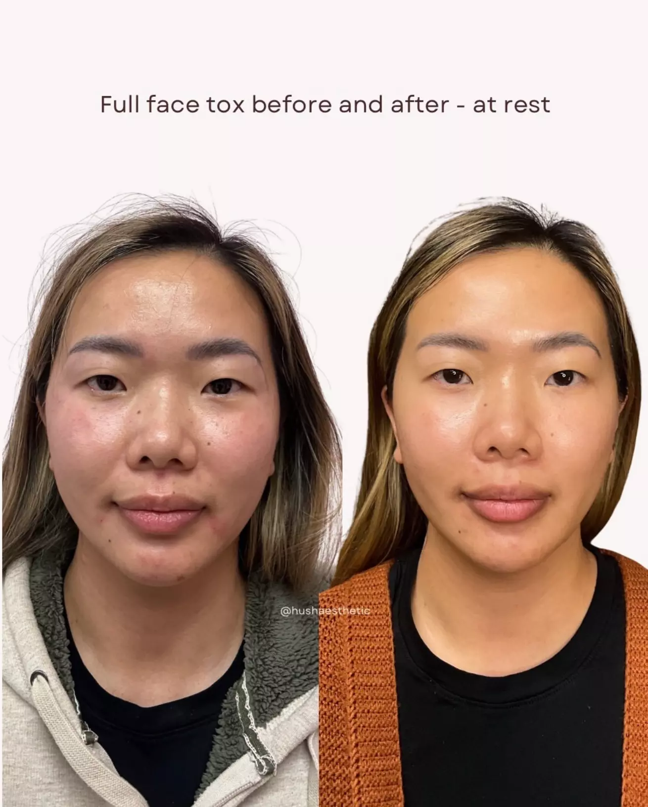 Up to 45% Off on Injectables at Hush Aesthetics, LLC