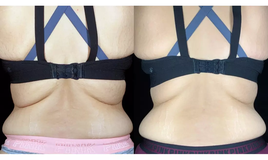 Tone with Five Sessions of Body Sculpting - Small or Large Area