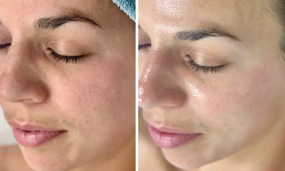 Up to 55% Off on Facial - Chosen by Customer at Rise Skin Spa