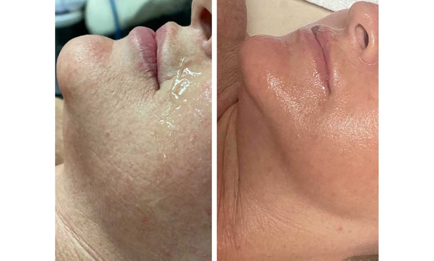 Image 6: One, Two, or Three 60-Minutes Belle Hydra Rejuvenation Sessions